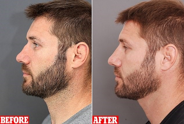 Non-Surgical Nose Rhinoplasty